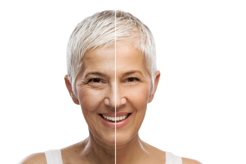 Older woman looking youthful after PDO Thread Lift