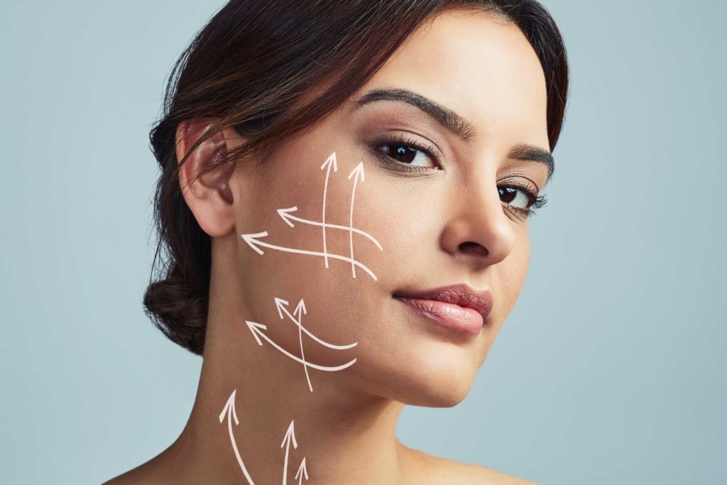 Woman with thread lift lines on face