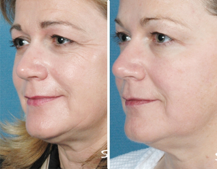 Side-by-side images showing a woman's face before (left) and after (right) a cosmetic procedure at a Reno medical spa, highlighting changes in skin smoothness and reduction of wrinkles.