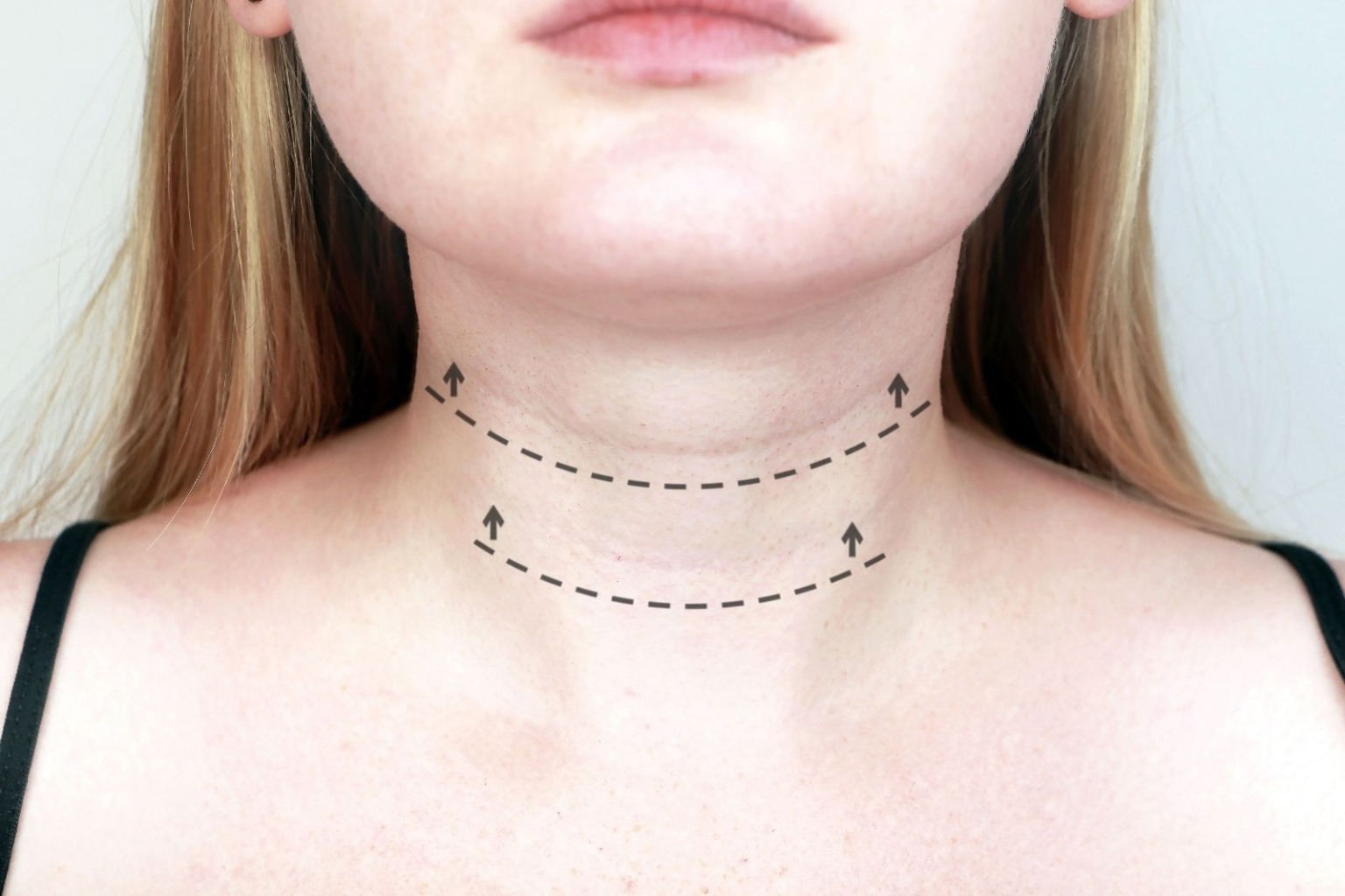 what-causes-neck-bands-and-how-to-treat-them-aesthetics-medspa