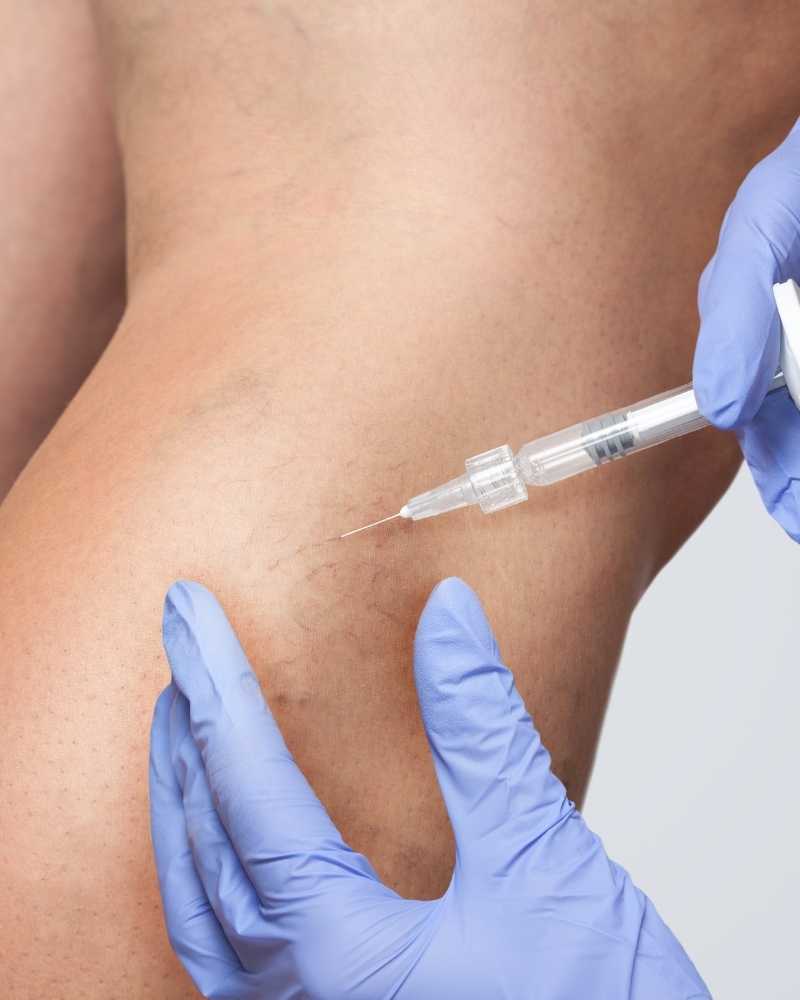 Injecting spider veins for sclerotherapy