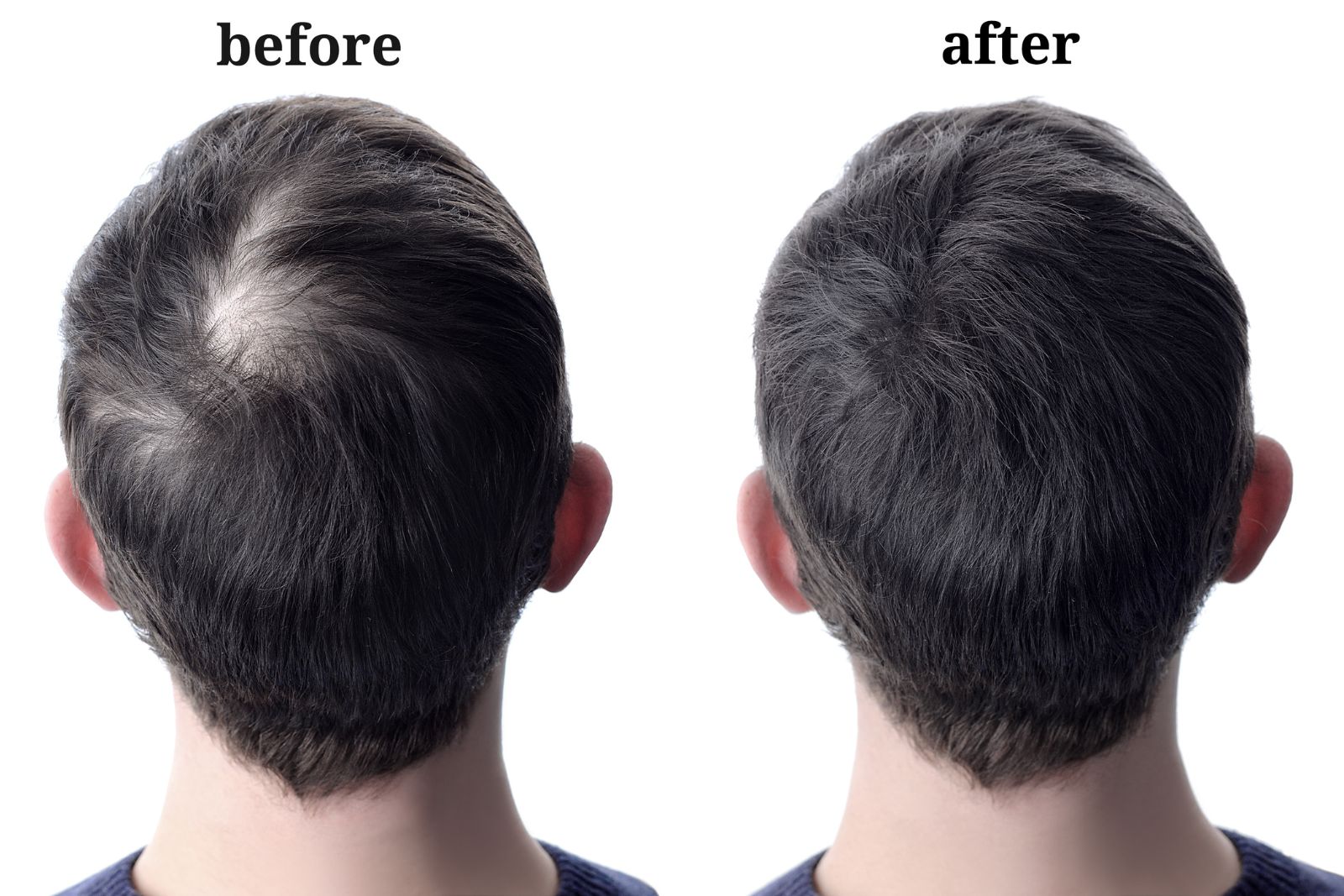 Men hair after using cosmetic powder for hair thickening. Before and after