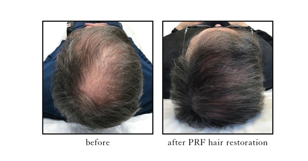 PRF-hair-restoration