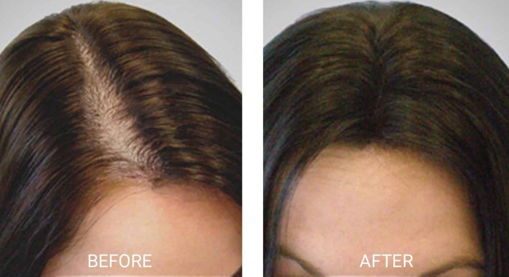 Side-by-side comparison of hair before and after treatment at Aesthetics Med Spa in Reno, showing reduced visibility of the scalp in the after image.