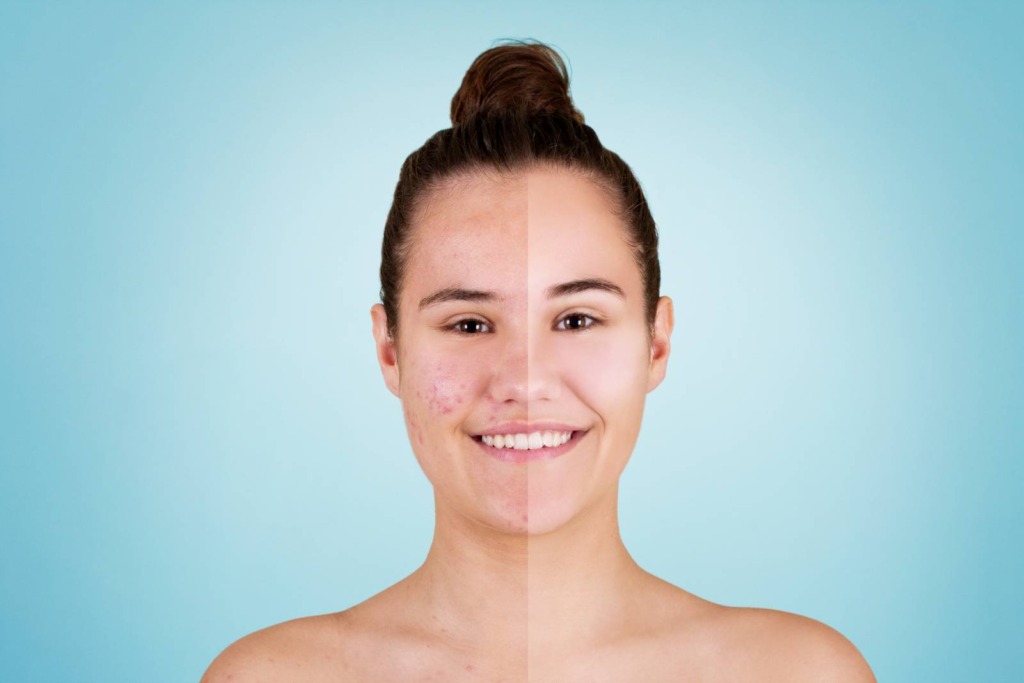 Split image of a person with blemished skin on the left and clear skin on the right, set against a blue background, showcasing a remarkable transformation typical of treatments at Reno's renowned aesthetics med spa.