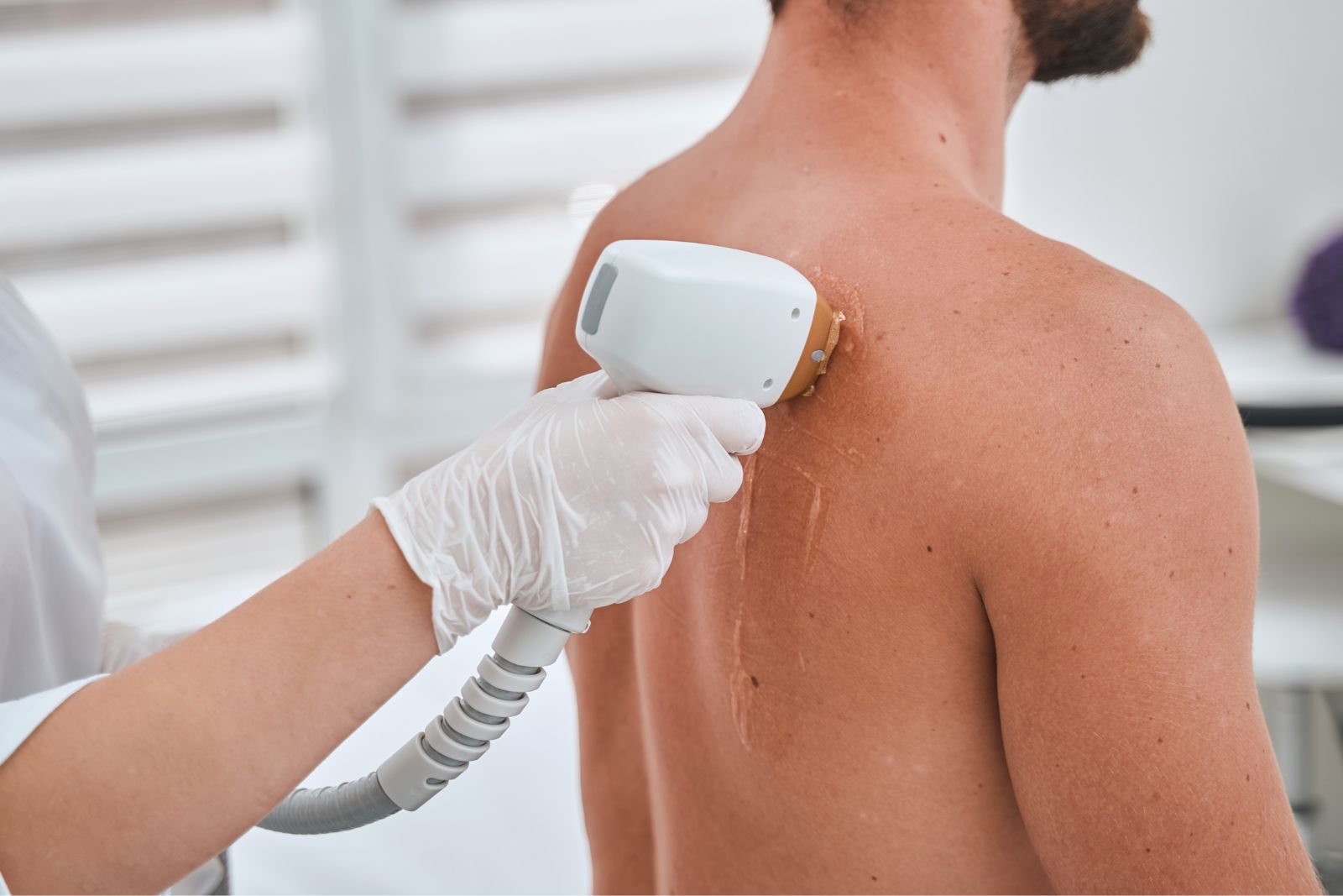 A person receiving laser hair removal treatment on their back. A gloved professional is using a handheld device during the procedure, ensuring precision and comfort throughout the session.