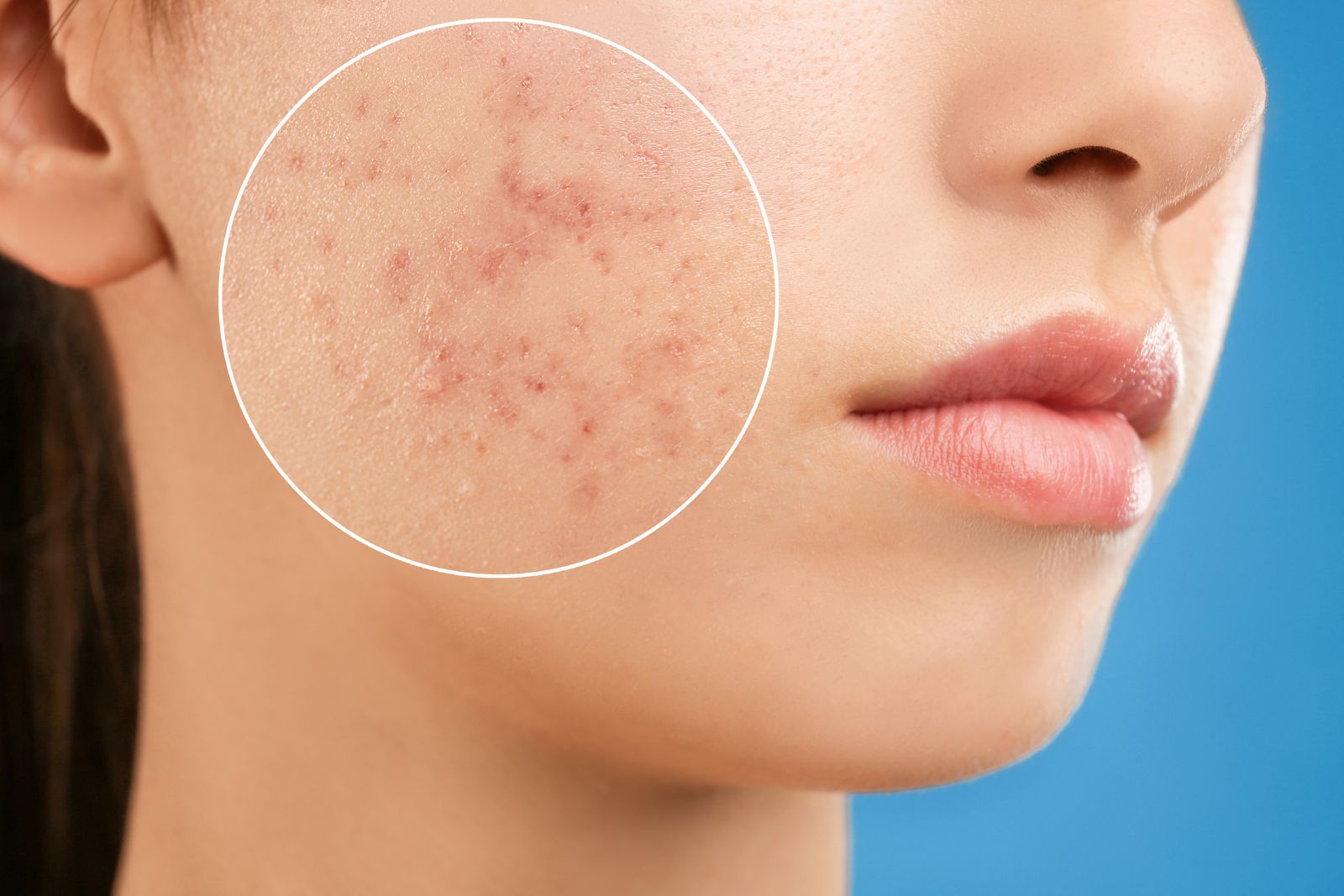 Close-up of a woman's face focusing on acne problems, with a magnified circle highlighting the affected skin.