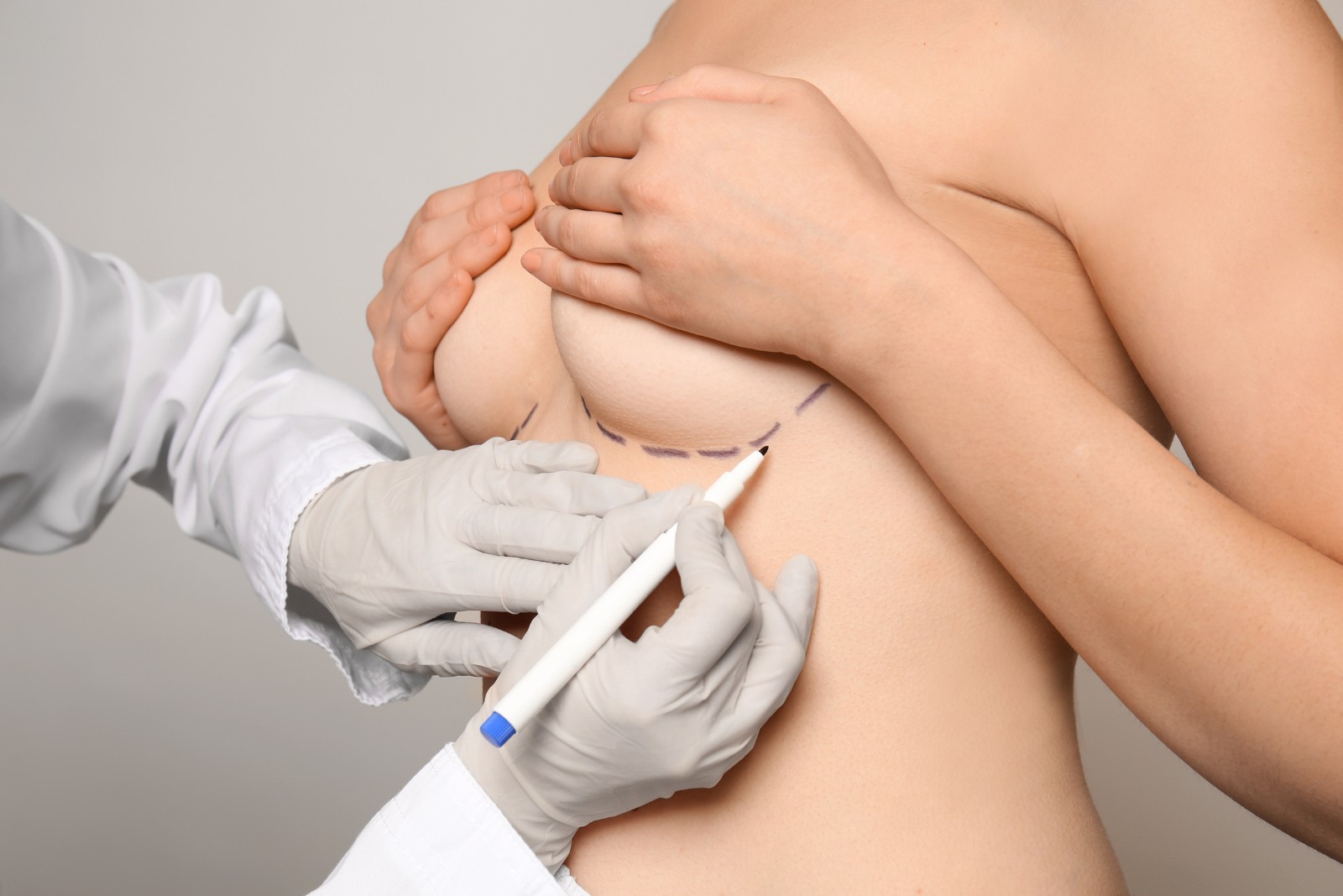 A person in a medical coat and gloves is making surgical markings on another person's breast with a purple marker while the individual covers their chest with their hands.