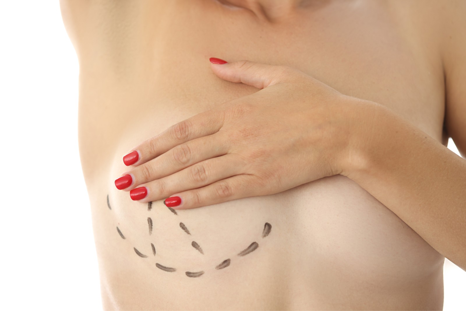 A topless person with one hand covering their breast. Marking lines indicating a surgical plan are drawn on the chest. The person's nails are painted red.