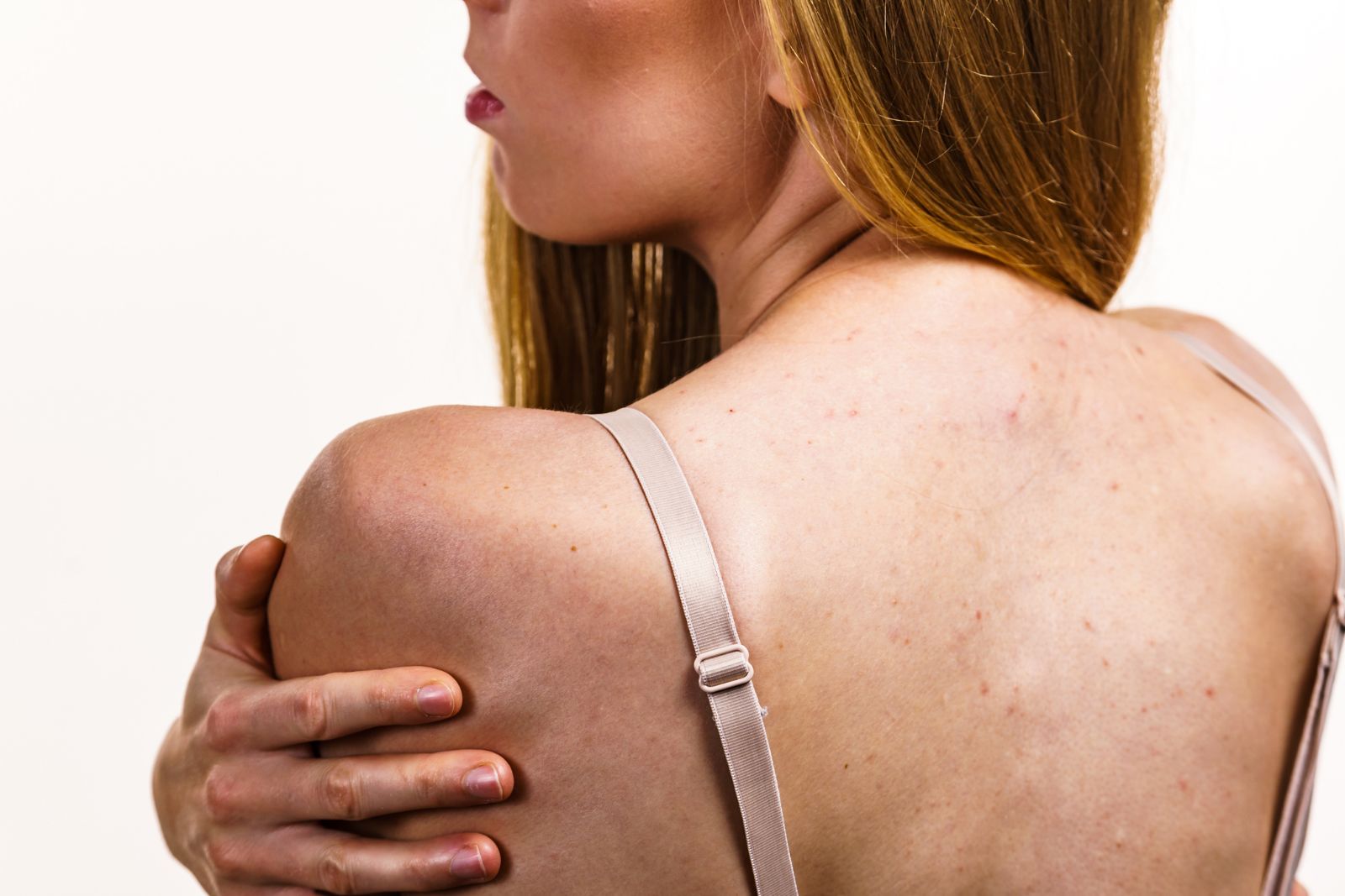 Close-up of a person's back, showing shoulder acne and blemishes. The person is wearing a beige bra and grasping their shoulder with the left hand, possibly considering a chemical peel on the back to address skin concerns.