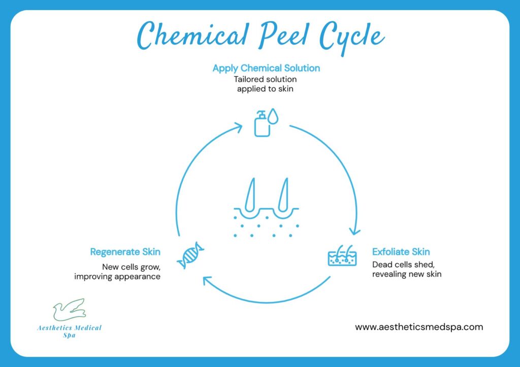 Diagram explaining the Chemical Peel on Back cycle: apply chemical solution, exfoliate skin as dead cells shed, then regenerate skin with new cell growth.