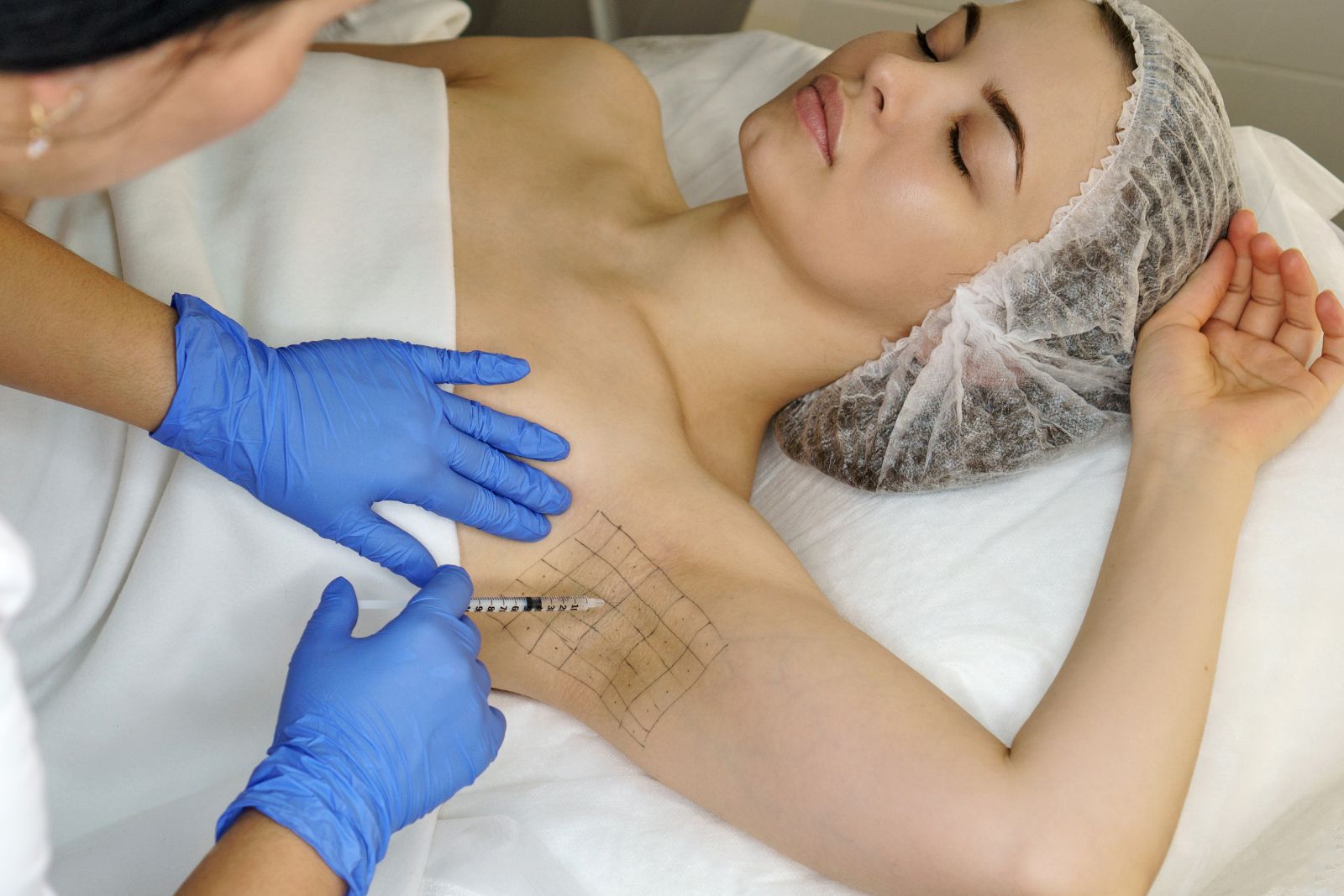 A woman lies down with her eyes closed as a person wearing blue gloves administers botox for underarms on a marked with a grid pattern. This precise procedure of armpit botox, popular in Reno, aims to treat excessive sweating.