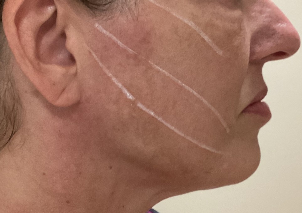 A person's face in profile with white marks on the cheek, suggesting planned cosmetic enhancements at a renowned aesthetics med spa.