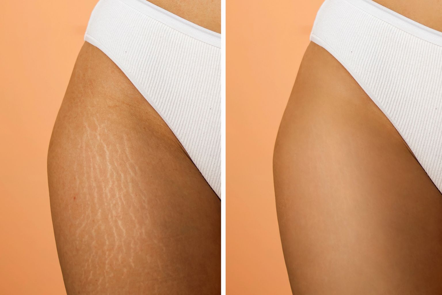 Side-by-side comparison of a thigh showing stretch marks on the left and smoother skin on the right, set against a peach background.