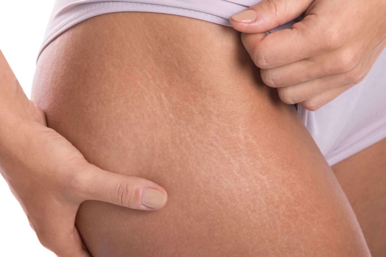 Close-up of a person's hand gripping their thigh, showing light stretch marks on the skin.