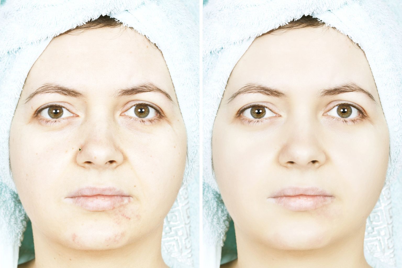 Side-by-side comparison of a woman's face before and after skincare treatment, showing improvement in skin texture and tone.