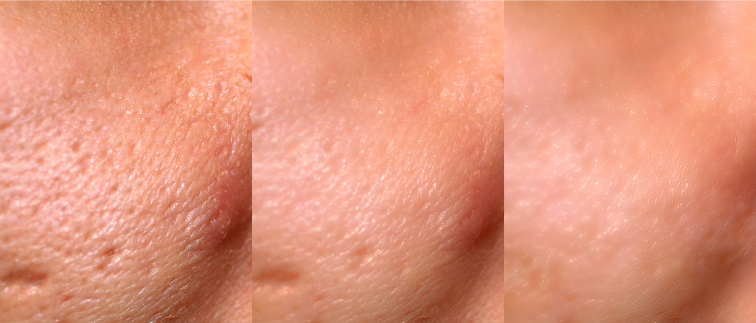 microneedling for acne scars