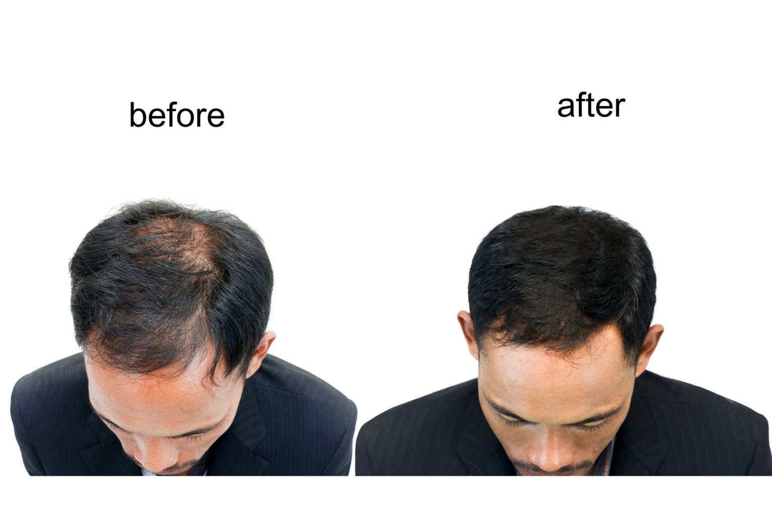 Microneedling for Hair Loss