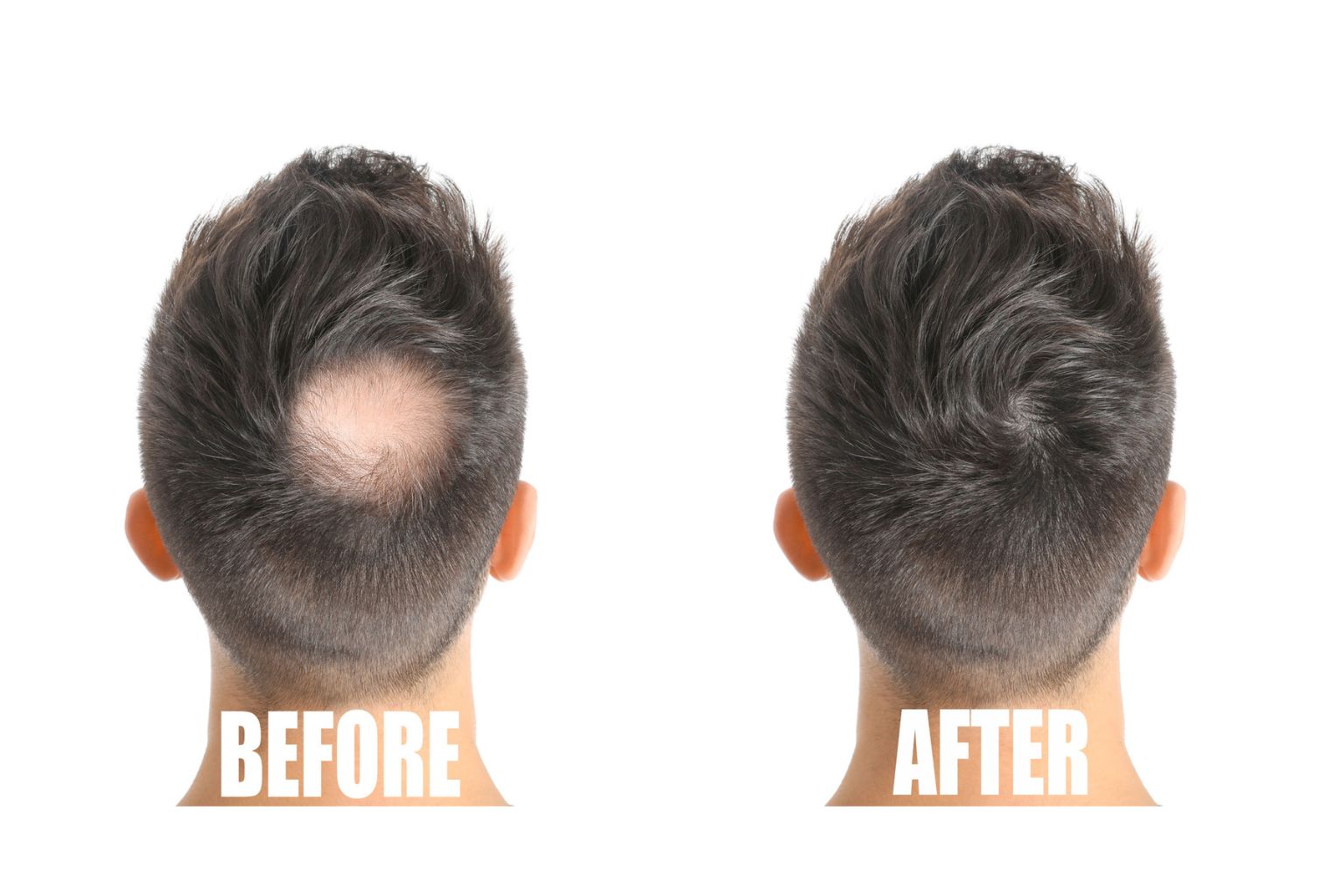 Before and after images of the back of a person's head reveal impressive hair regrowth on a previously bald spot, thanks to the benefits of microneedling for hair growth. Discover how microneedling the scalp can transform your look.