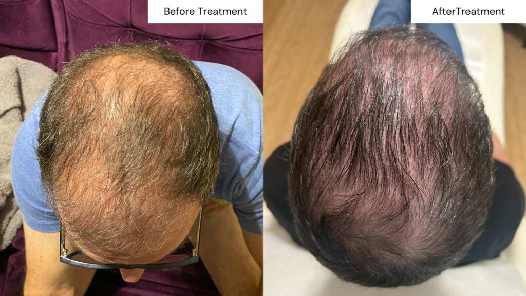 Before and after comparison illustrating the enhanced hair density on top of a person's head following PRP treatment for hair.