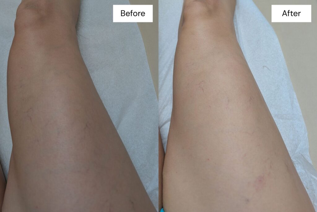 Side-by-side comparison of a person's leg before and after Laser Vein Therapy in Reno, showing reduced visibility of veins or discoloration in the "After" image.