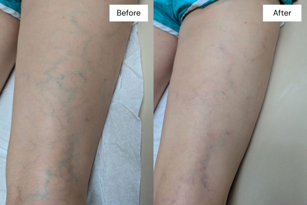 Side-by-side comparison of a leg before and after Laser Vein Therapy in Reno; visible veins on the left are significantly reduced on the right.