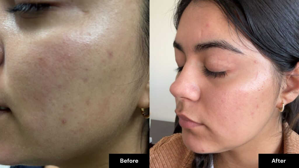 Side-by-side comparison of a woman’s cheek before and after Cosmetic Peels in Reno, showing reduced redness and acne in the "after" image.