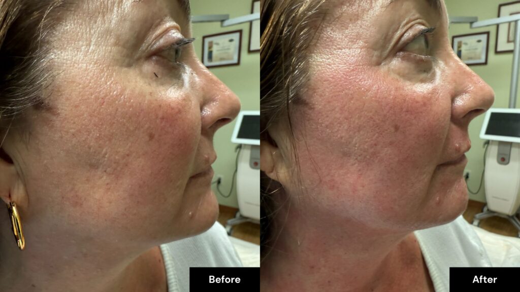 Side-by-side photos of a woman’s face in Reno highlight the "before" and "after" effects of laser skin resurfacing, with the "after" image displaying smoother and more even-toned skin.