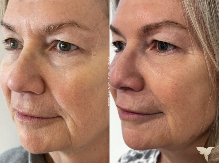 Side-by-side comparison of a woman's face before and after PRF Injections in Reno, showing smoother skin and reduced wrinkles in the after image.