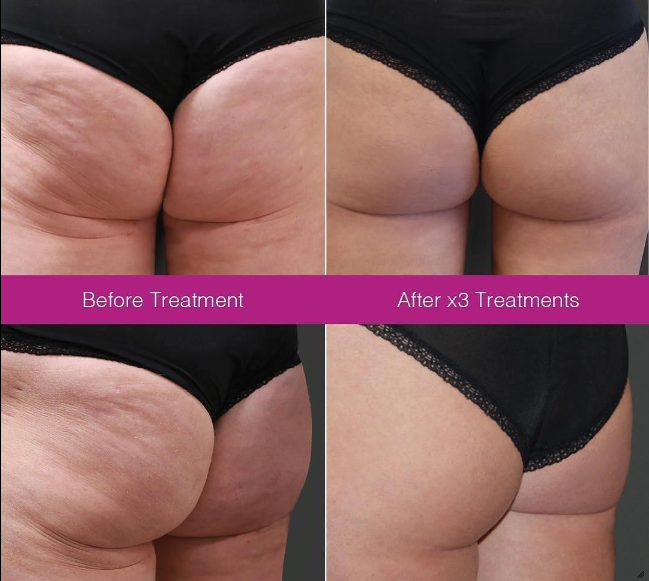 Side-by-side comparison of the back of a woman's upper legs and buttocks before and after three Velashape body contouring treatments in Reno, showing reduced cellulite and smoother skin.