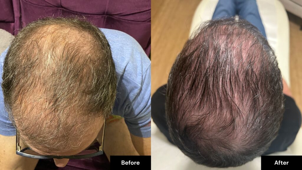Top view comparison of a person's scalp before and after PRF Hair Restoration in Reno, showcasing noticeably increased hair density and coverage in the "after" image.