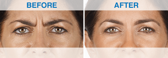 Side-by-side photos show a woman's face before and after xeomin injections in Reno, with the "after" image revealing reduced frown lines and noticeably smoother skin.