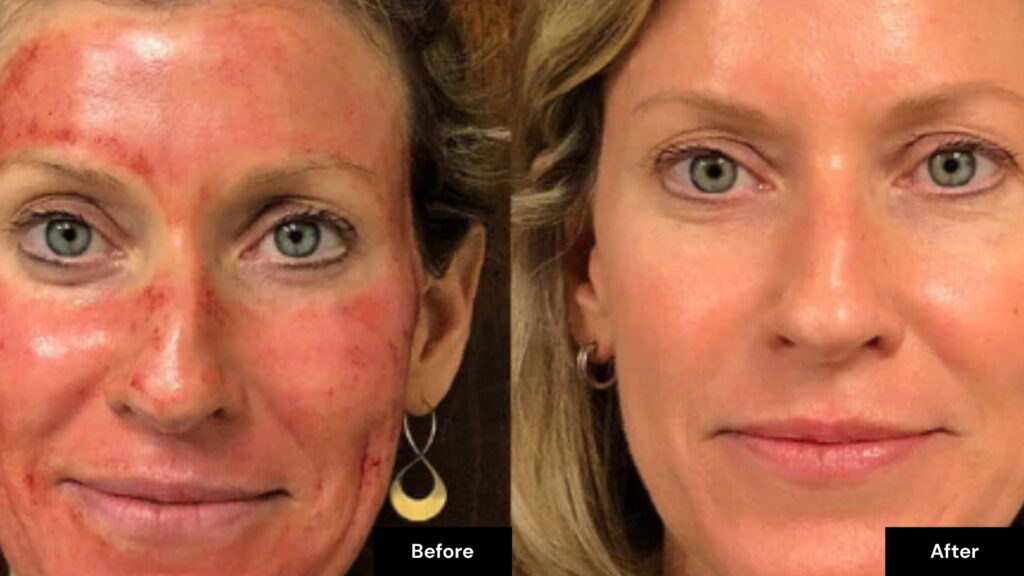 Side-by-side comparison of a woman's face before and after platelet plasma facial; the left shows redness and irritation, the right shows clear, even-toned skin.