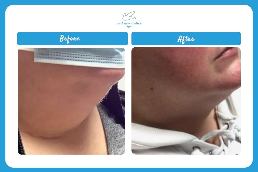 Side-by-side comparison of a person’s chin and neck area before and after Kybella treatment in Reno, showing reduced fullness in the after photo.