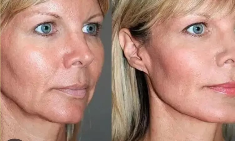 Side-by-side comparison of a woman’s face before and after a cosmetic procedure, featuring ReFirme skin tightening. The after image shows smoother skin and improved jawline contour, highlighting the rejuvenating effects of this popular treatment in Reno.